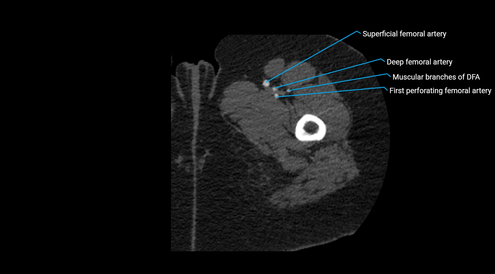 CTA lower limb cross sectional anatomy labelled image _82.webp